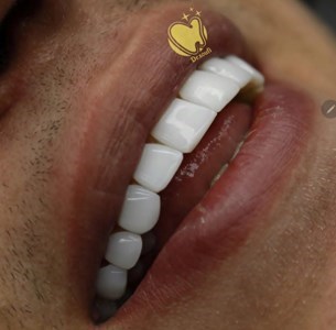 دکتر زهرا صوفی نژاد کامپوزیت ونییر,لمینت سرامیکی,اندو,پروتز جراح دندانپزشک در تهران